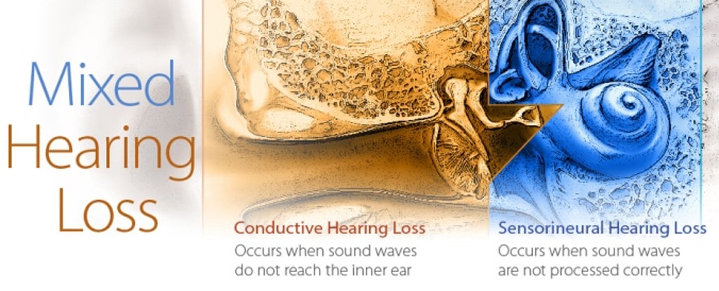 Sensorineural hearing loss